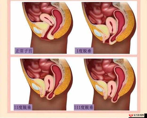 女性生殖系统疾病科普：阴挺病是怎么回事